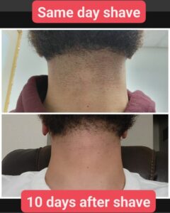 Laser hair removal — back of neck before and after at S Glowic MedSpa, Plano TX — treatment by Samah Haroof